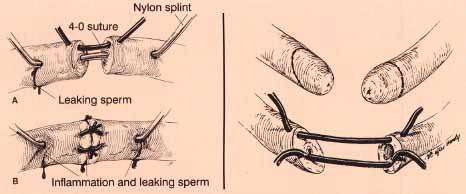 Relatively crude surgical techniques like those depicted above will occasionally be successful, but this usually results in scarring down with a poor channel for sperm to go through leading to poor sperm quality and no pregnancy. Eventually such a crude channel scars down completely and the patient has very few or no sperm coming through.