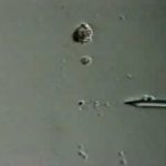 Sertoli Cell Sperm Aspiration for ICSI procedure