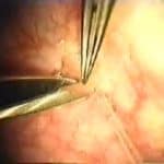 Sperm Aspiration: removing sperm from the epididymis