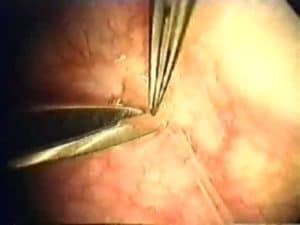 Sperm Aspiration: removing sperm from the epididymis
