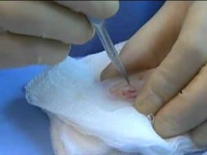 Vitrification of ovarian tissue to preserve fertility
