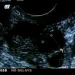 Antral Follicle Count Predicts Biological Clock