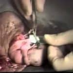 Microsurgery For Male Infertility