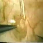 Microsurgical End-to-Side Vasoepididymostomy - Part 1