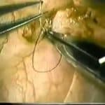 Microsurgical End-To-Side Vasoepididymostomy - Technical Video