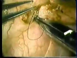 Microsurgical End-To-Side Vasoepididymostomy - Technical Video