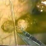 Microsurgical Vasectomy Reversal:Technical Video