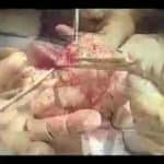 Osada Procedure for Massive Adenomyosis: Preserving Uterus