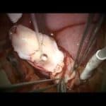 Ovarian tissue transplant - Infertility Center of St. Louis