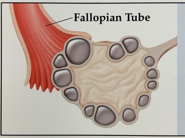 PCOS (Polycystic Ovary Syndrome) The Infertility Center of St. Louis