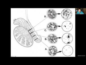 Dr Sherman Silber Azoospermia