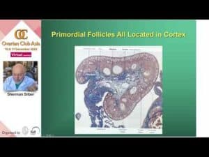 2022 Asian Ovarian Club Talk by Dr. Sherman Silber